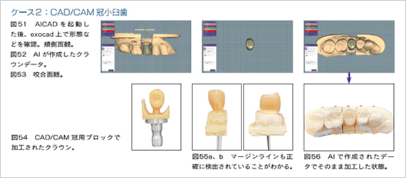 CAD/CAM冠小臼歯