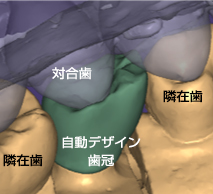 対合歯 隣在歯 自動デザイン歯冠