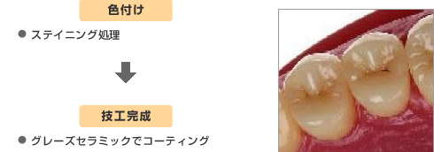 色付け・技工完成