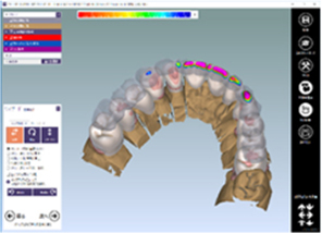 デンタルCAD