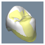 補綴物計測データ